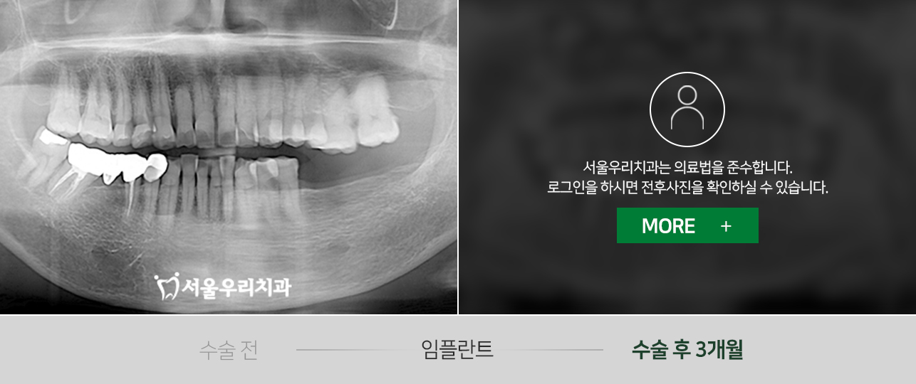 임플란트-전후사진1