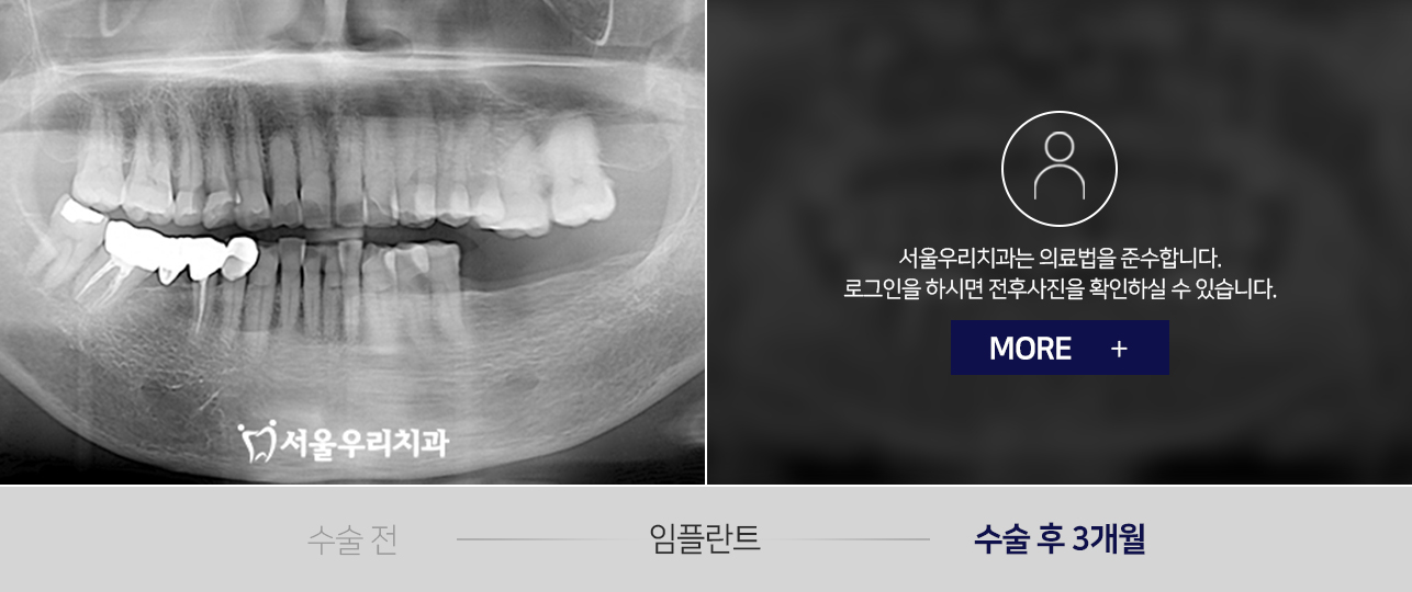 임플란트-전후사진1