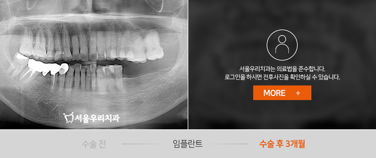 임플란트-전후사진1