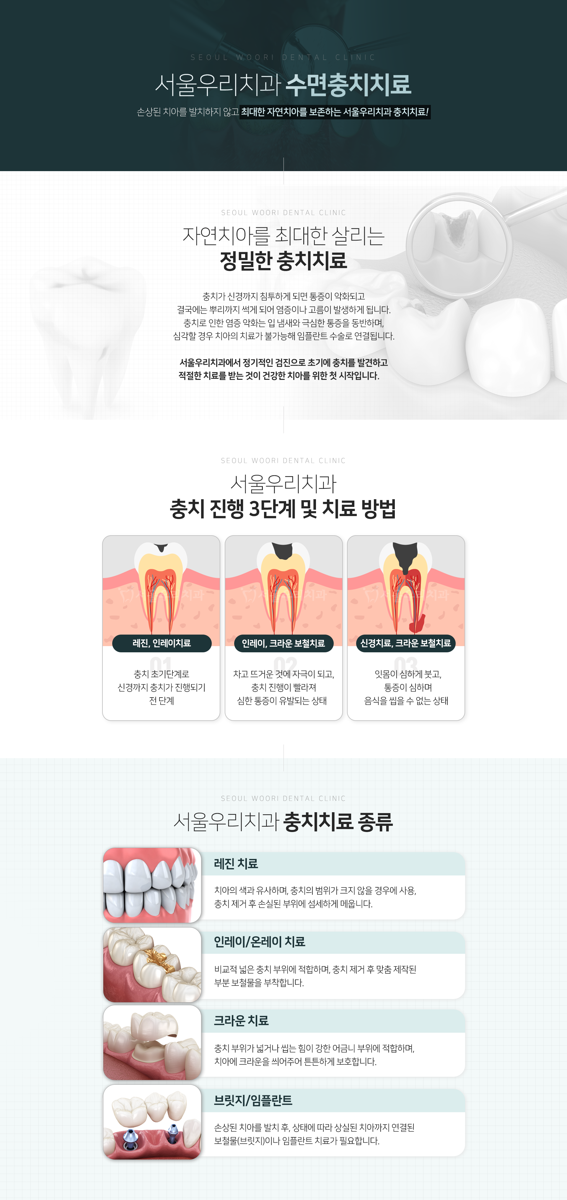 서울우리치과-수면-충치치료-충치-진행-단계-및-치료-방법-1단계-충치-초기-단계로-신경까지-충치가-진행되기-전-단계-치료방법-레진-인레이-치료-2단계-차고-뜨거운-것에-자극이-되고-충치-진행이-빨라져-심한-통증이-유발되는-상태-치료방법-인레이-크라운-보철치료-3단계-잇몸이-심하게-붓고-통증이-심하며-음식을-씹을-수-없는-상태-치료방법-신경치료-크라운-보철치료-충치치료-종류1-레진-치료-치아의-색과-유사하며-충치의-범위가-크지-않을-경우에-사용-종류2-인레이/온레이-치료-비교적-넓은-충치-부위에-적합하며-충치-제거-후-맞춤-제작된-부분-보철물을-부착합니다-종류3-크라운-치료-충치-부위가-넓거나-씹는-힘이-강한-어금니-부위에-적합하며-치아에-크라운을-씌워주어-튼튼하게-보호합니다-종류4-브릿지/임플란트-손상된-치아를-발치-후-상태에-따라-상실된-치아까지-연결된-보철물인-브릿지나-임플란트-치료가-필요합니다