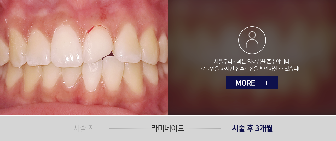 라미네이트-전후사진1