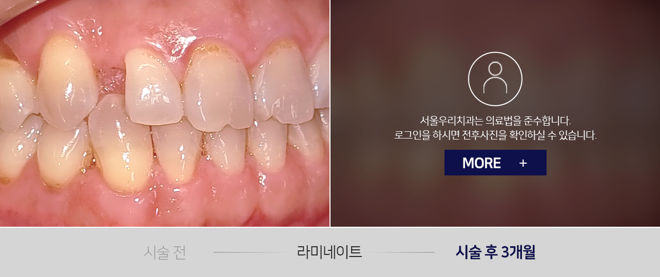 라미네이트-전후사진2